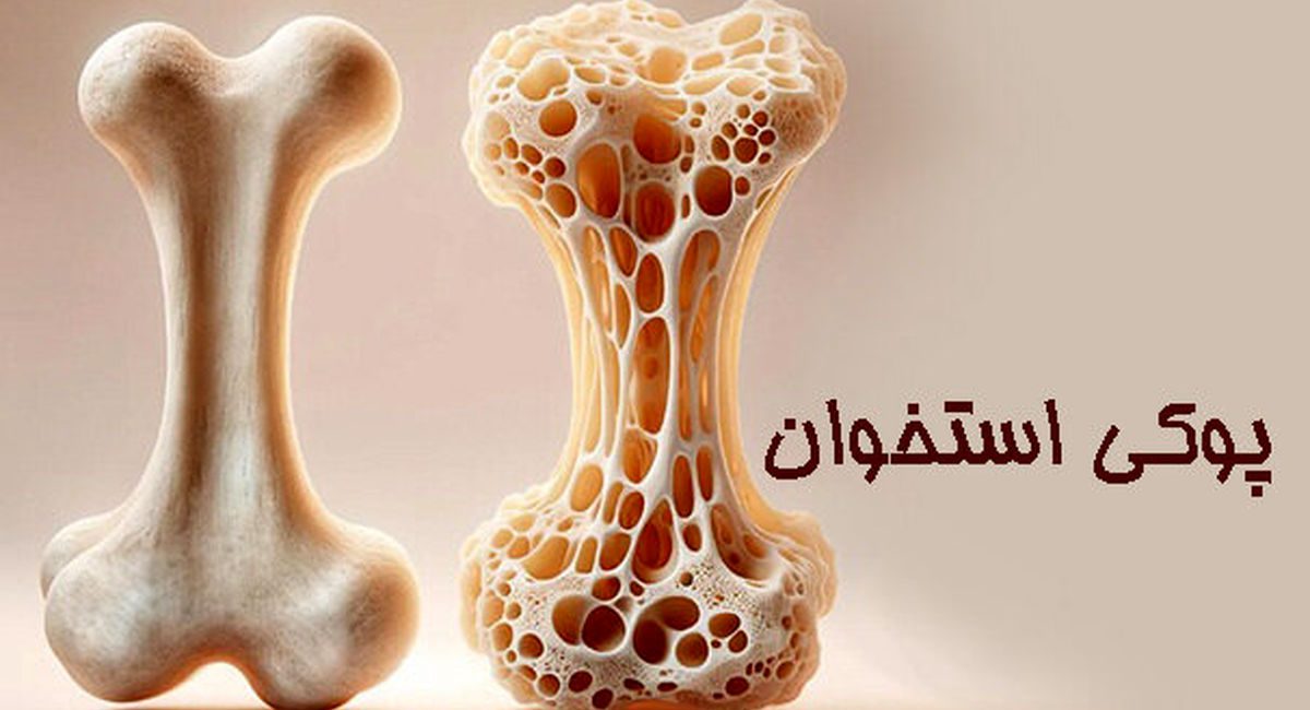 پوکی استخوان