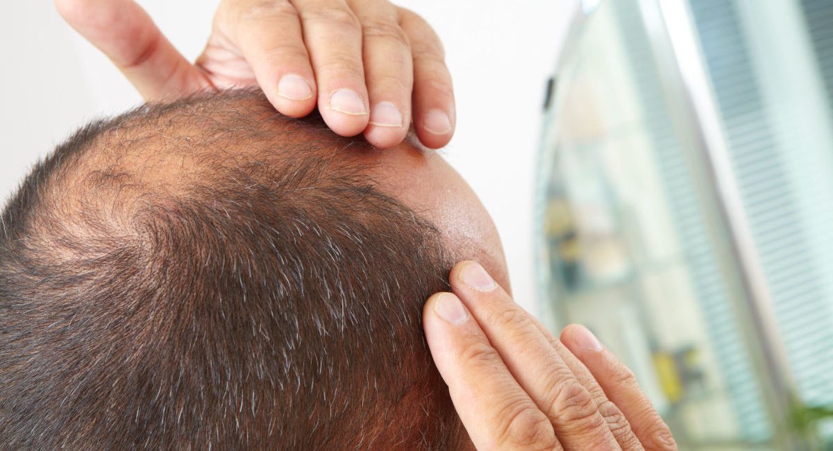 ریزش مو با نسخه طب سنتی